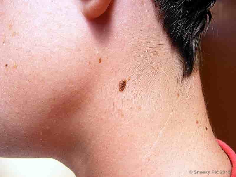 Skin Mole