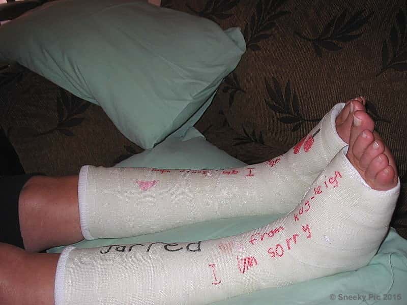 Plaster Cast on Feet